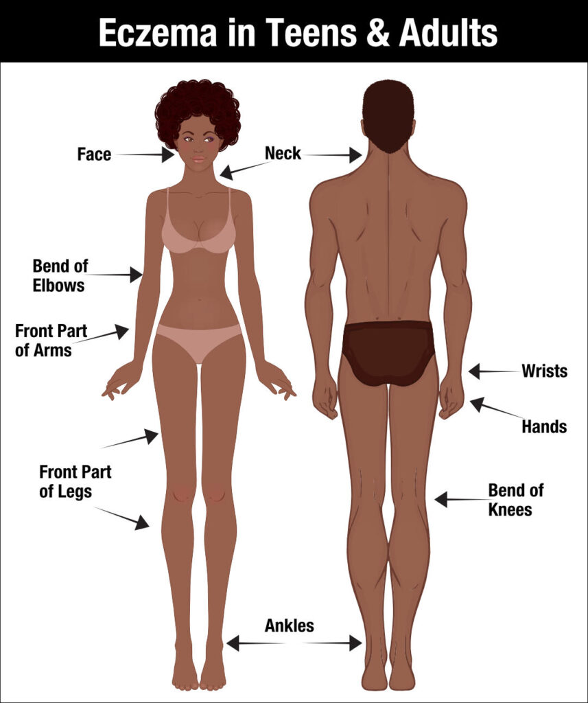 Illustration showing eczema locations in teens and adults, with arrows pointing to the face, neck, front part of arms and legs, bend of elbows and knees, wrists, hands, and ankles on a woman (front) and a man (back).