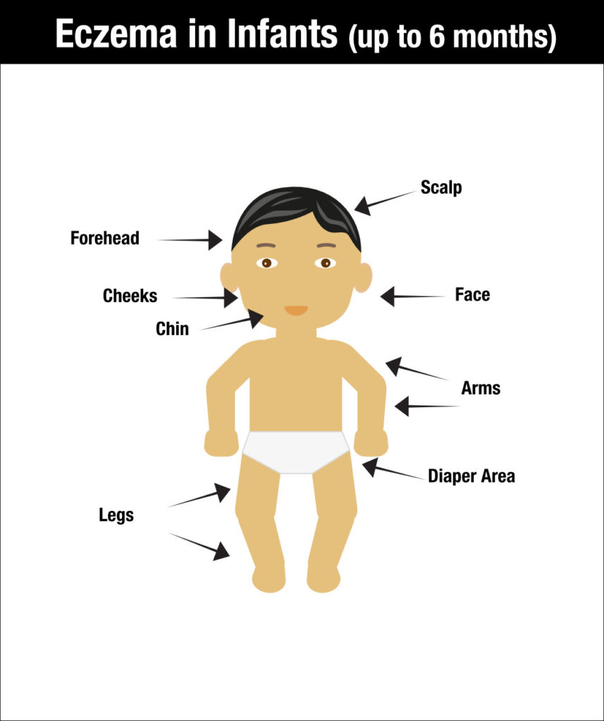 Illustration of a baby in a diaper with arrows pointing to areas commonly affected by eczema in infants: scalp, forehead, cheeks, chin, face, arms, legs, and diaper area. Title reads "Eczema in Infants (up to 6 months).