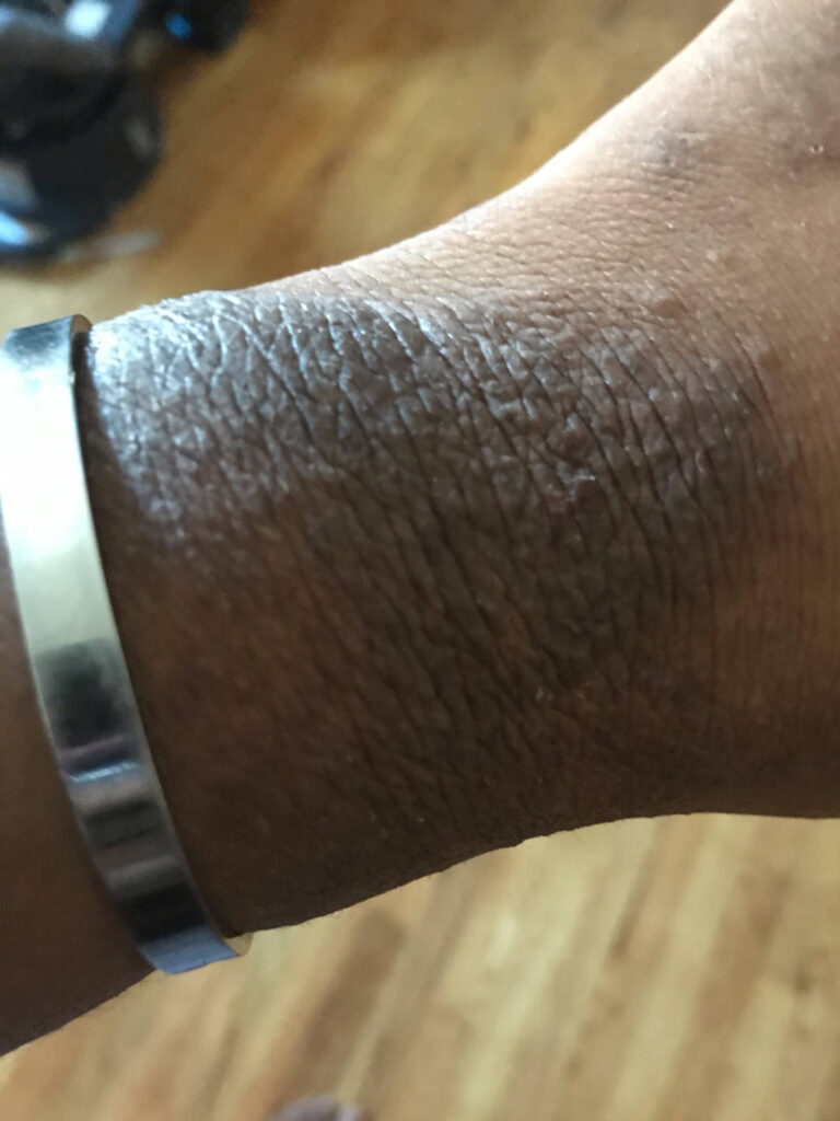 A close-up of a person's wrist with dry, cracked, and flaky skin wearing a silver bracelet. The background is blurred with a wooden floor visible.