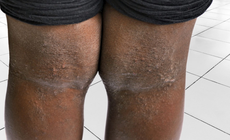 Close-up of the back of two knees with dry, scaly, and darkened skin, showing signs of eczema or dermatitis. The person is standing on a white tiled floor, wearing dark shorts.