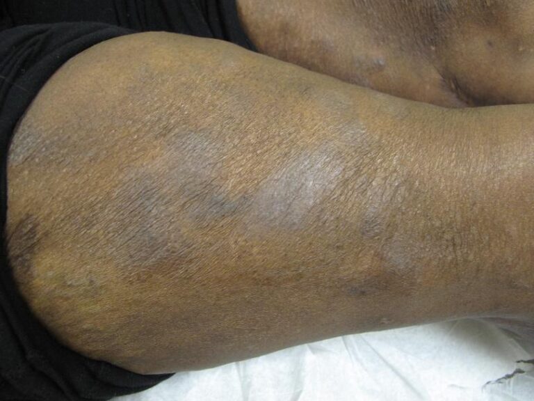 A close-up of a person's leg with patches of lighter and darker skin, showing areas of discoloration, dryness, and rough texture. The person is lying down on a medical exam table.