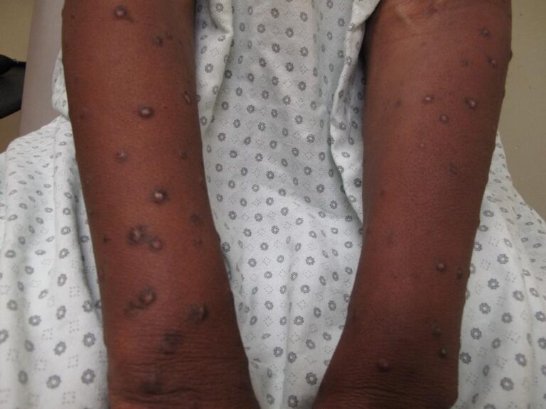 Una persona de piel oscura que viste una bata de hospital tiene múltiples lesiones o bultos oscuros y elevados repartidos por ambos antebrazos.