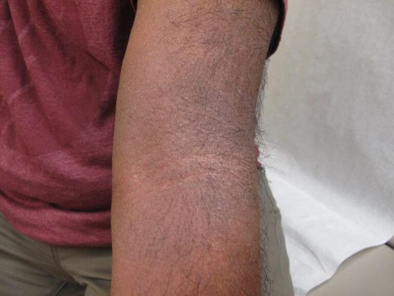 A close-up of a person's bent arm showing dry, scaly, and slightly discolored skin, possibly indicating a skin condition such as eczema or dermatitis. The person is wearing a maroon shirt and tan pants.