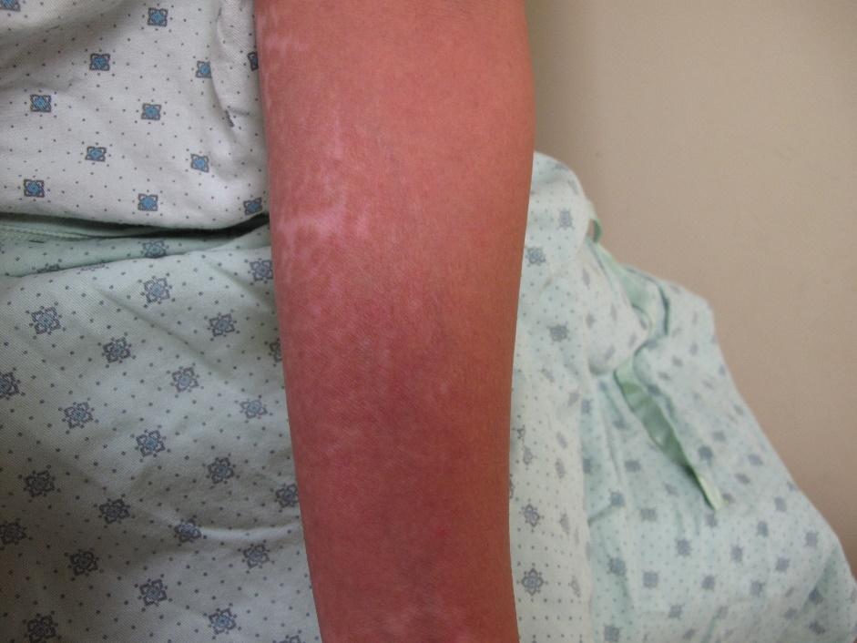 Atopic dermatitis on arm of a person with Brown skin showing hypopigmentation