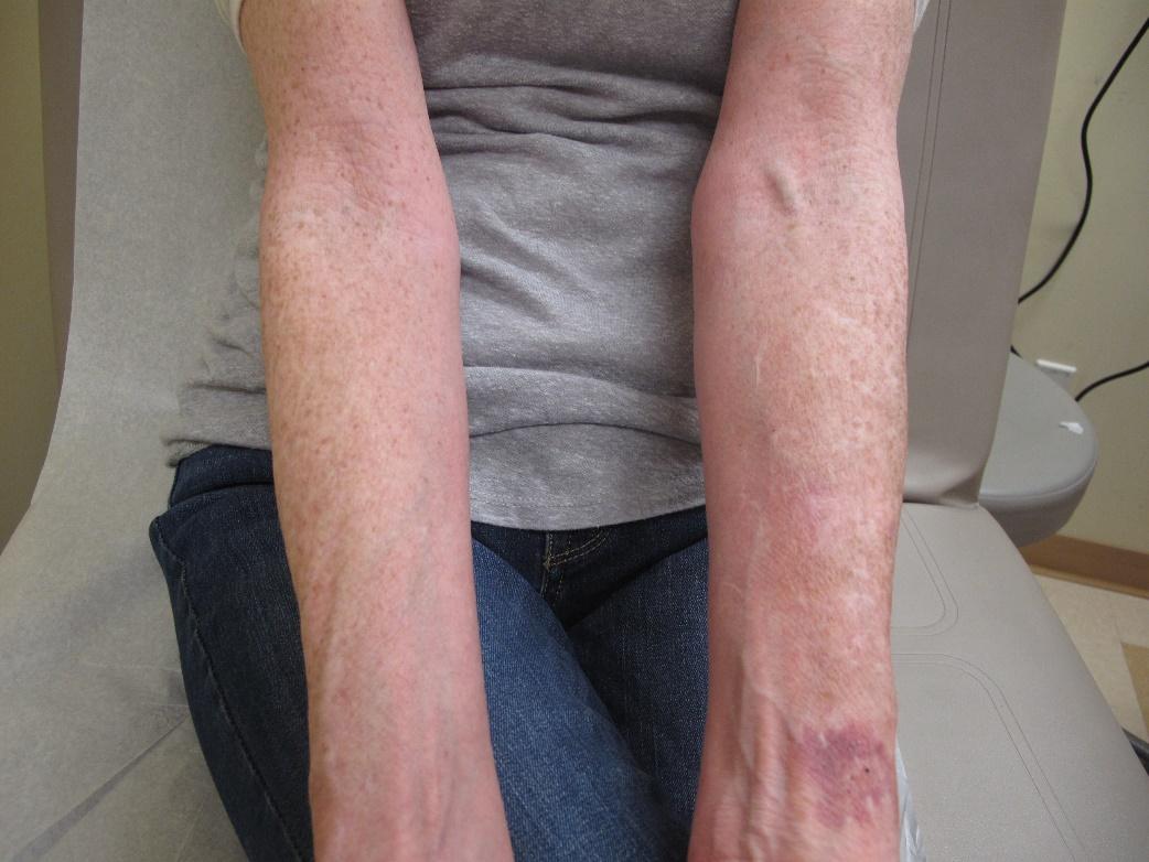 Dermatitis atópica en el brazo/muñeca de una persona con piel blanca que muestra hipopigmentación, eccema