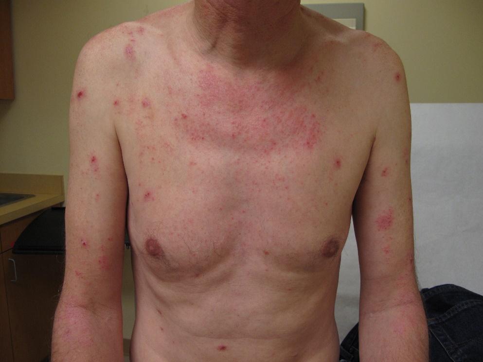 Una persona sin camisa con múltiples erupciones y lesiones rojas, elevadas y que pican en el pecho, los hombros y la parte superior de los brazos, sentada en una sala de examen médico.