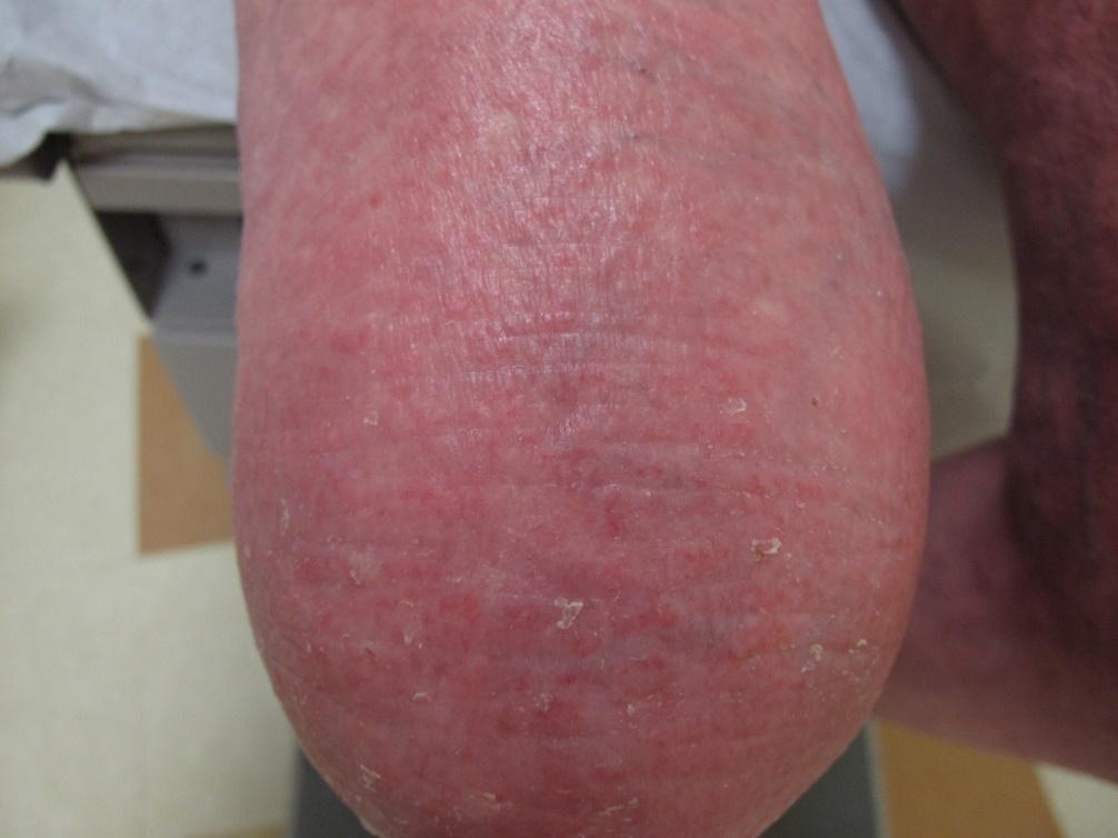 Atopic dermatitis on elbow/arm of a person with White skin showing erythema and lichenification