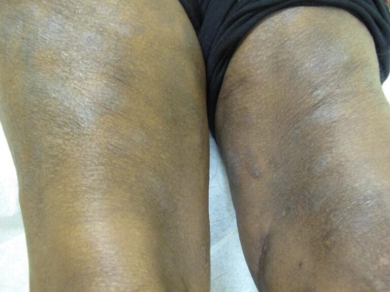 Two dark-skinned legs with areas of discoloration and scarring rest on a white surface. The right leg shows more visible patches and marks compared to the left. The person is wearing black clothing.