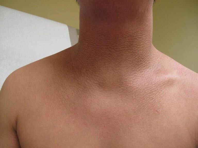 Un primer plano del cuello y la parte superior del pecho de una persona que muestra la piel engrosada, oscurecida y estriada, una afección conocida como acantosis nigricans, comúnmente asociada con la resistencia a la insulina.