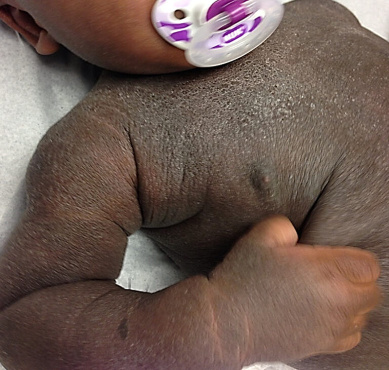 An infant with dark skin is lying on a white surface, holding a purple and white pacifier. The skin appears dry and rough, showing patches of scaling and small bumps on the arm and shoulder.