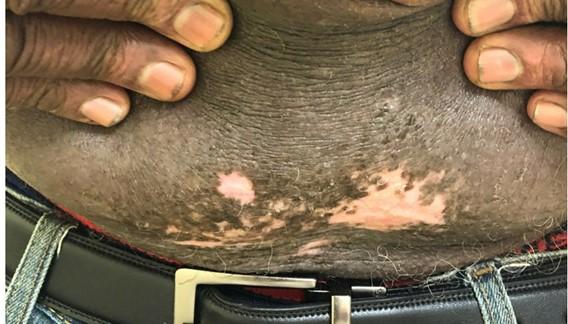 A person pulls up their shirt to reveal patches of lighter and darker skin with irregular borders on the lower abdomen, just above the belt, suggesting a skin condition or pigmentation disorder.