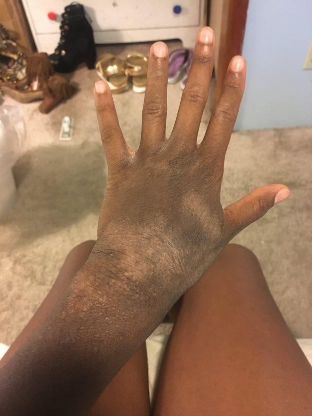 A hand with dry, patchy, and discolored skin is held out in front of crossed legs. In the background, there are shoes, gold containers, and a white dresser on a carpeted floor.