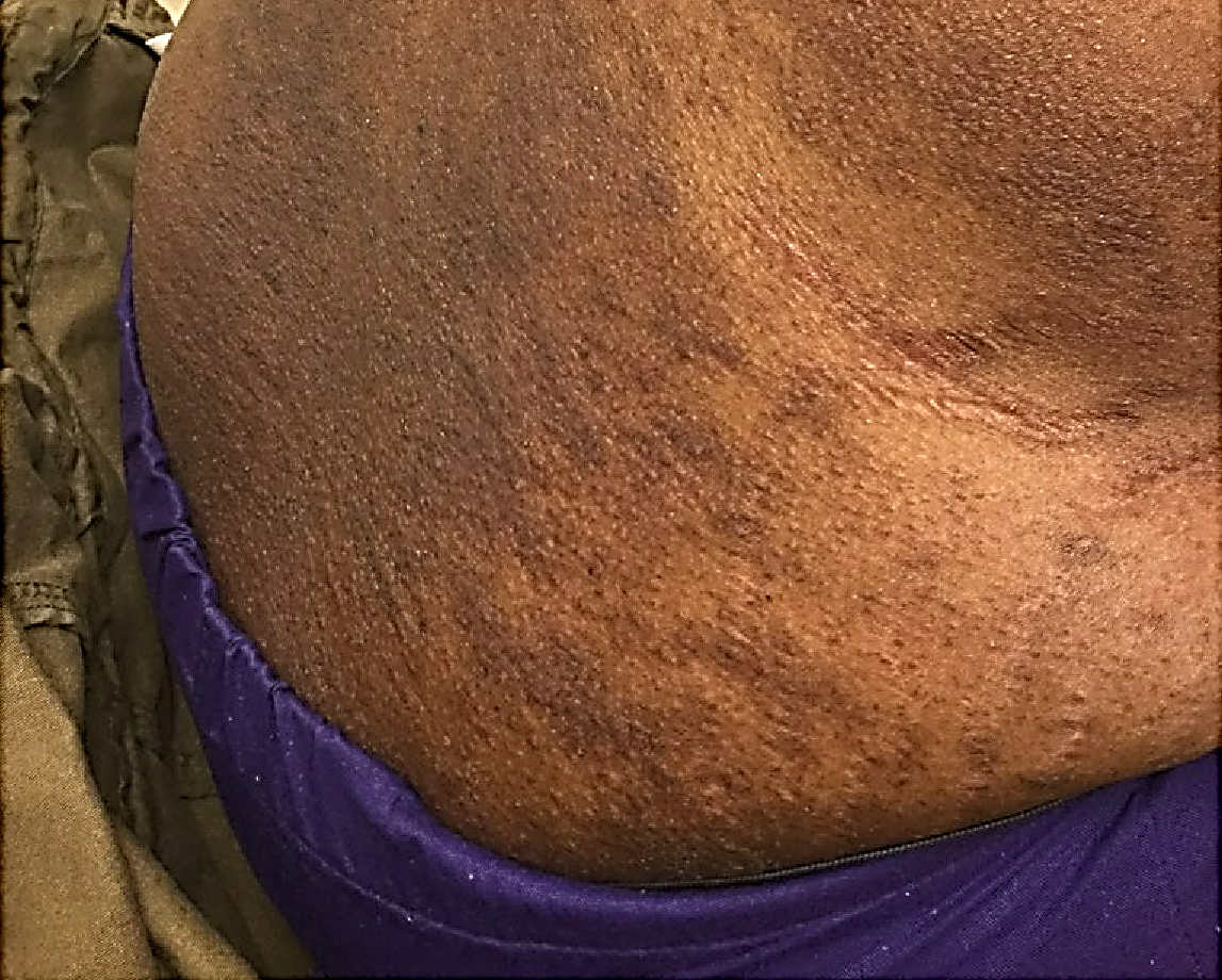 Topical Steroid Side Effect on torso of a person with Black skin showing striae