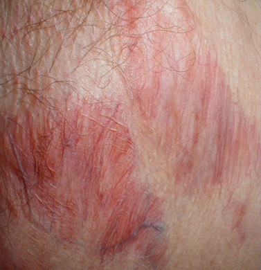 Topical Steroid Side Effect on a person with White skin showing skin atrophy