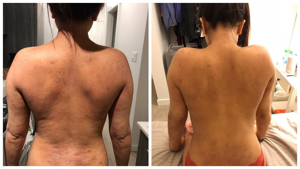 Atopic dermatitis on the back of a person with Brown skin showing scaly erythematous patches, dyspigmentation, hyperpigmentation and hypopigmentation