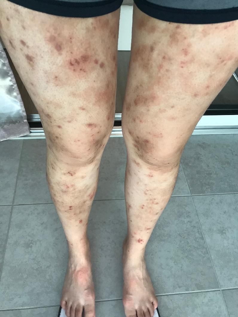 Dermatitis atópica en las piernas de una persona de piel morena que muestra placas eritematosas, parches eritematosos, excoriación e hiperpigmentación.