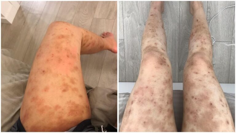 Two photos show legs with widespread red and dark spots, scars, and patches, indicating a skin condition or irritation. The left image shows one leg; the right image shows both legs extended on a light floor.