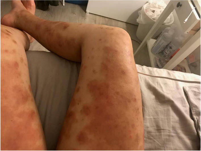 Eczema en piernas de una persona con piel morena, que presenta placas y parches eritematosos