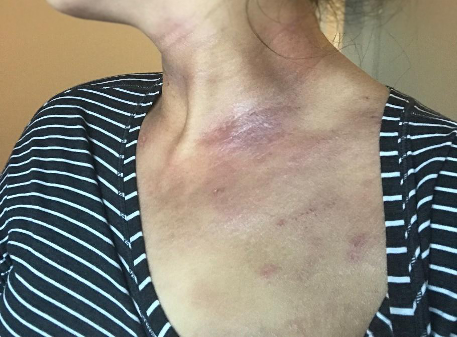 Dermatitis atópica en el cuello y el pecho de una persona de piel morena que muestra placa eritematosa escamosa, excoriación y parches eritematosos.