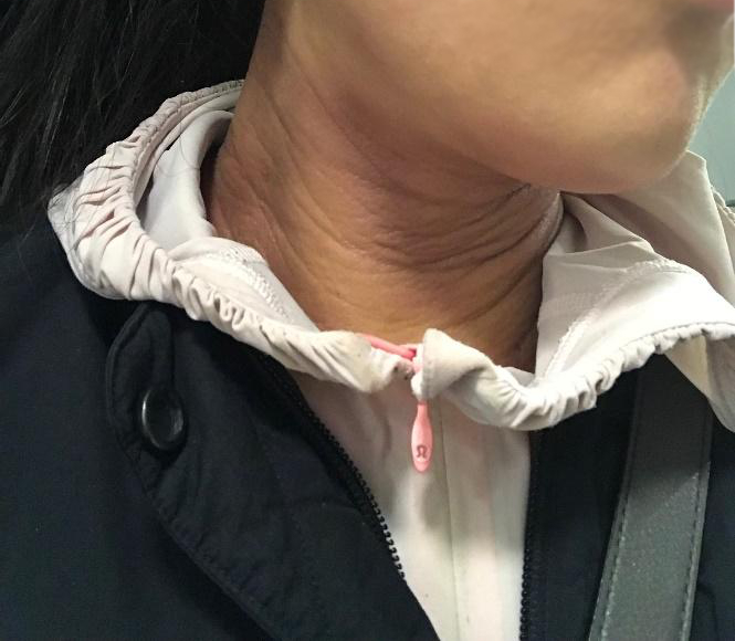 Dermatitis atópica en el cuello de una persona de piel morena que muestra placas eritematosas o psoriasiformes