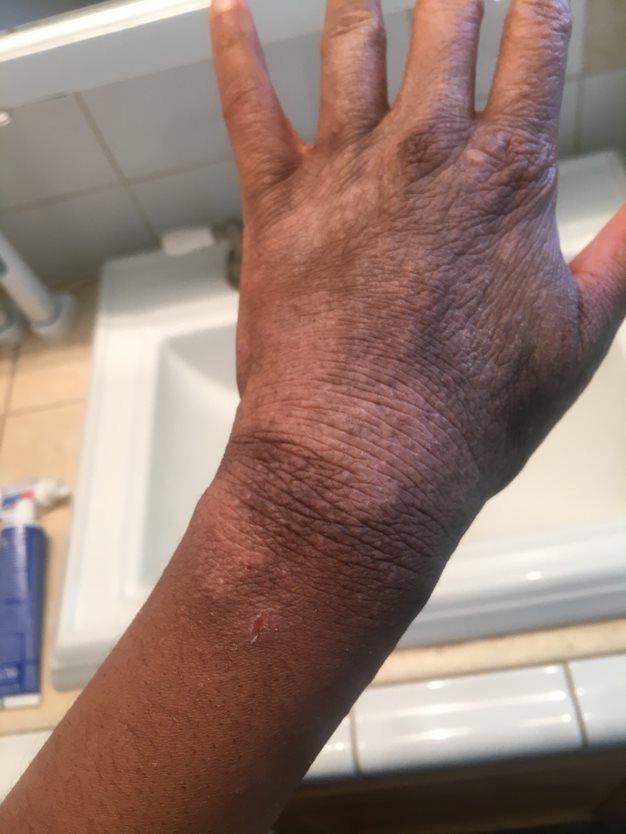 A close-up of a person's hand and wrist with dry, cracked skin and a small scratch, held over a bathroom sink with a tube of ointment visible on the counter in the background.