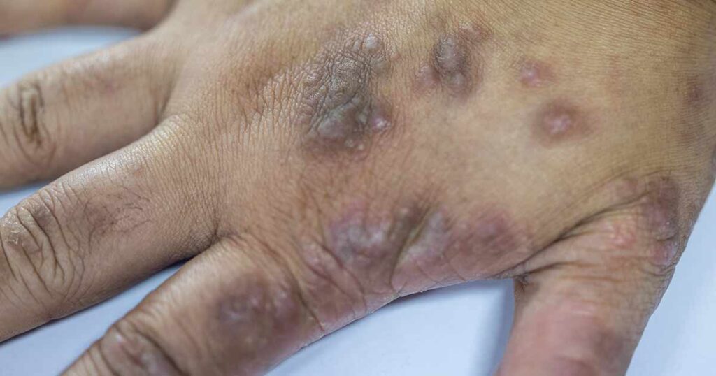 A close-up of a hand with several raised, discolored bumps and lesions on the skin, showing signs of irritation or possible infection.
