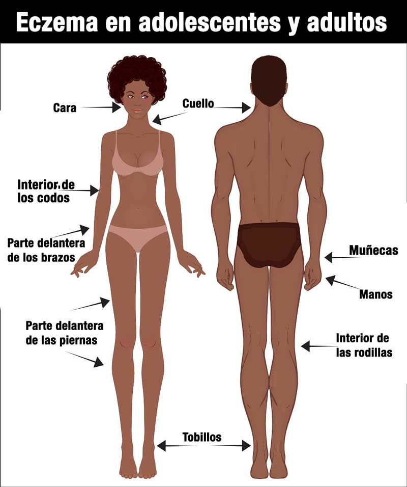 Ilustración que muestra la ubicación del eczema en adolescentes y adultos, con flechas que apuntan a la cara, el cuello, la parte delantera de los brazos y las piernas, el interior de los codos y las rodillas, las muñecas, las manos y los tobillos de una mujer (frente) y un hombre (espalda).