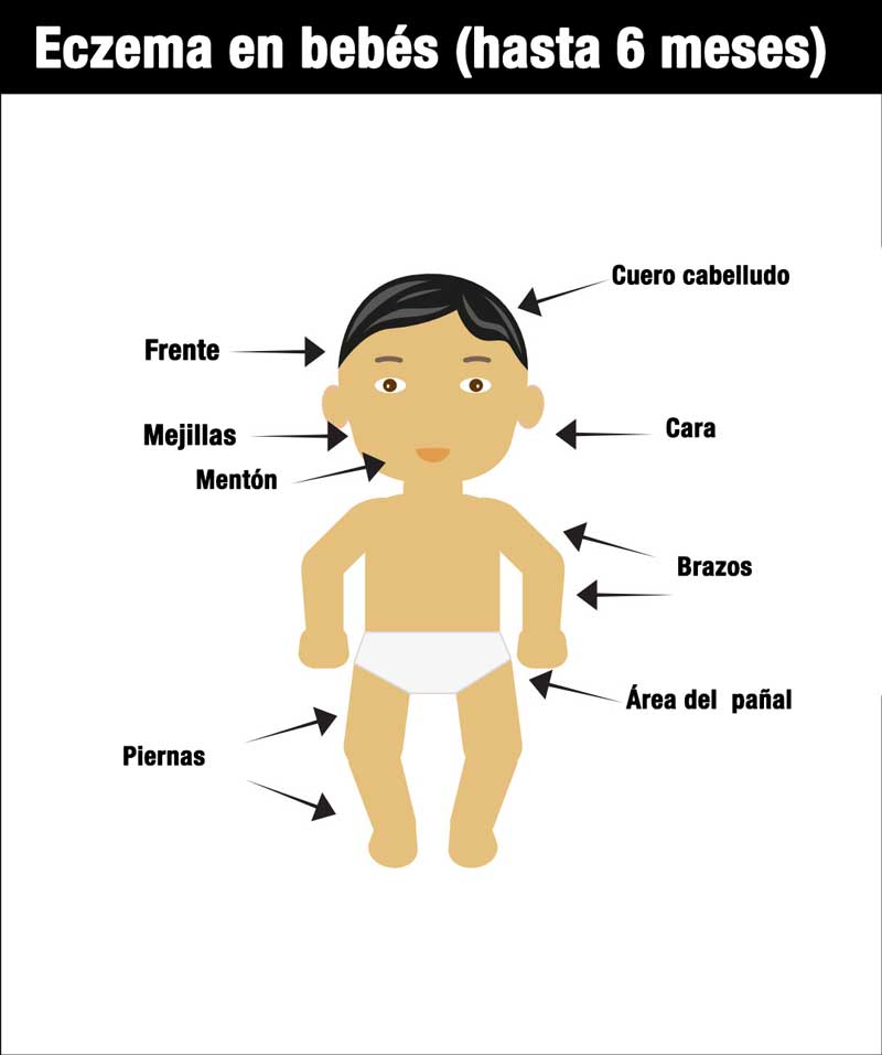Ilustración de un bebé con pañal con flechas que apuntan a las áreas comúnmente afectadas por el eczema en los bebés: cuero cabelludo, frente, mejillas, mentón, cara, brazos, piernas y área del pañal. El título dice: "Eczema en bebés (hasta 6 meses).