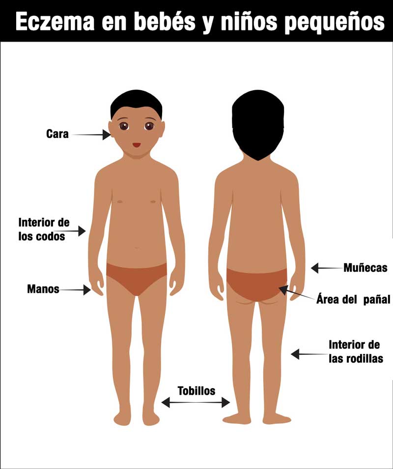 Ilustración de un niño de frente y de espaldas, que muestra las áreas comunes afectadas por el eczema, incluida la cara, el interior de los codos, las manos, las muñecas, los tobillos, el área del pañal y la curva de las rodillas.