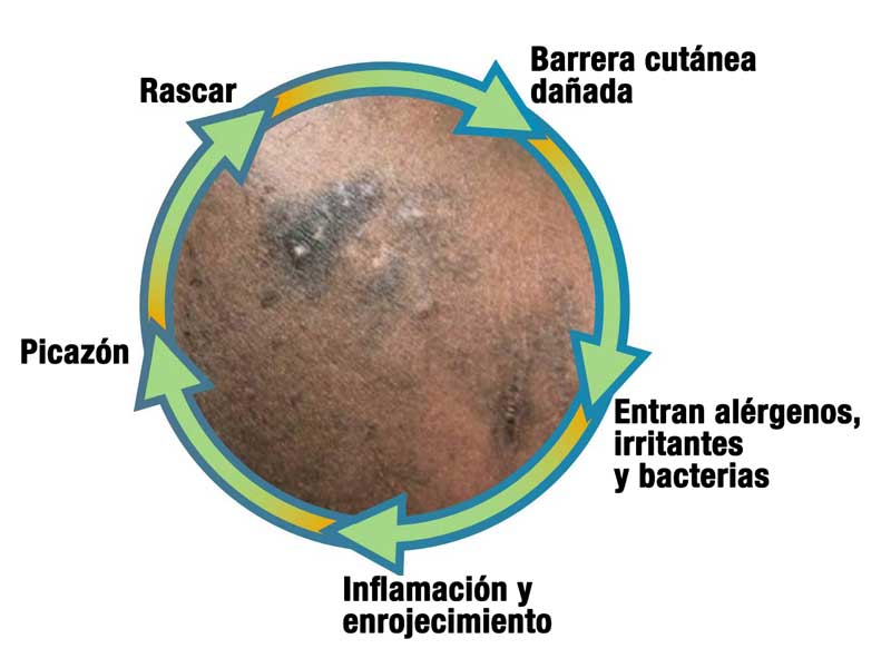 Un diagrama que muestra el ciclo de picazón y rascado en la piel: la barrera cutánea se daña, ingresan alérgenos/irritantes, se produce inflamación y enrojecimiento, lo que provoca picazón y rascado, repitiéndose el ciclo.