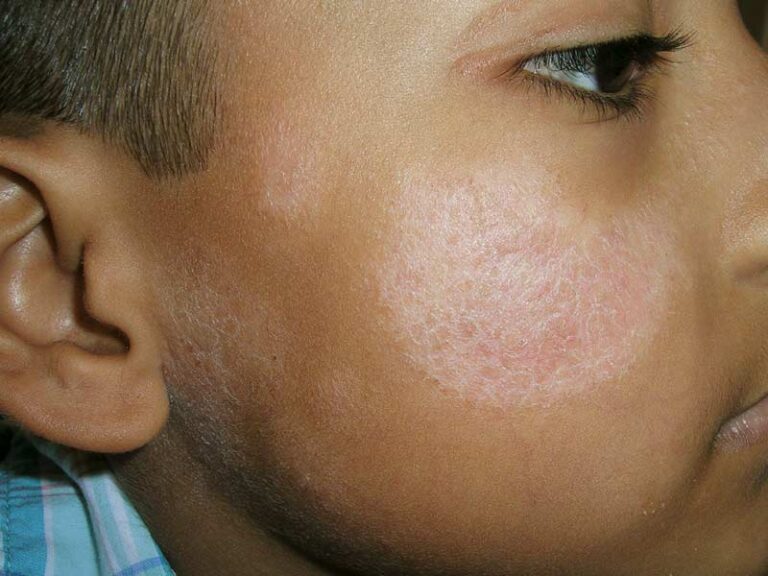 Un primer plano del rostro de un niño que muestra una mancha grande, redonda, roja y escamosa en la mejilla, lo que posiblemente indica una afección de la piel como la dermatitis atópica.