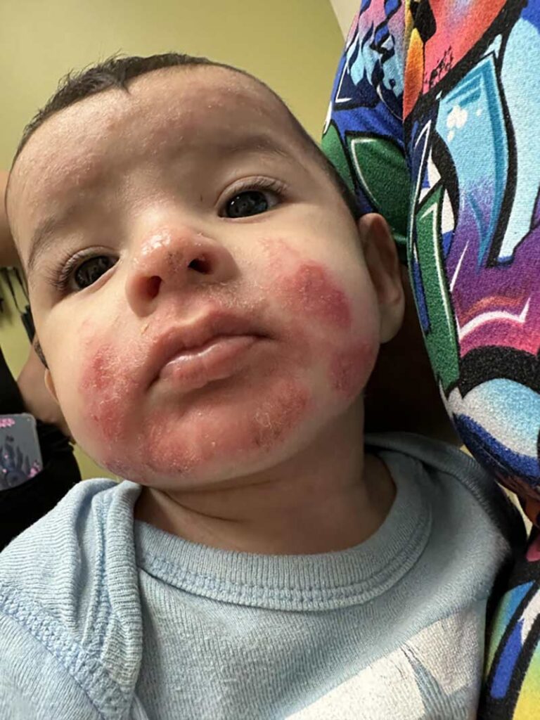 A baby with red, irritated, and inflamed patches on both cheeks is being held by someone wearing a colorful, patterned shirt. The baby looks up with a neutral expression.