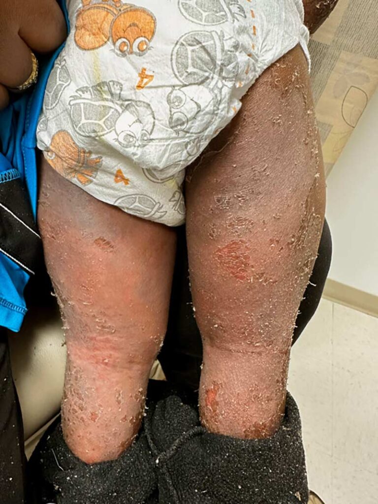 A young child wearing a diaper with cartoon prints has visibly dry, red, and scaly skin with patches of irritation and flaking on both legs, suggesting a severe skin condition.