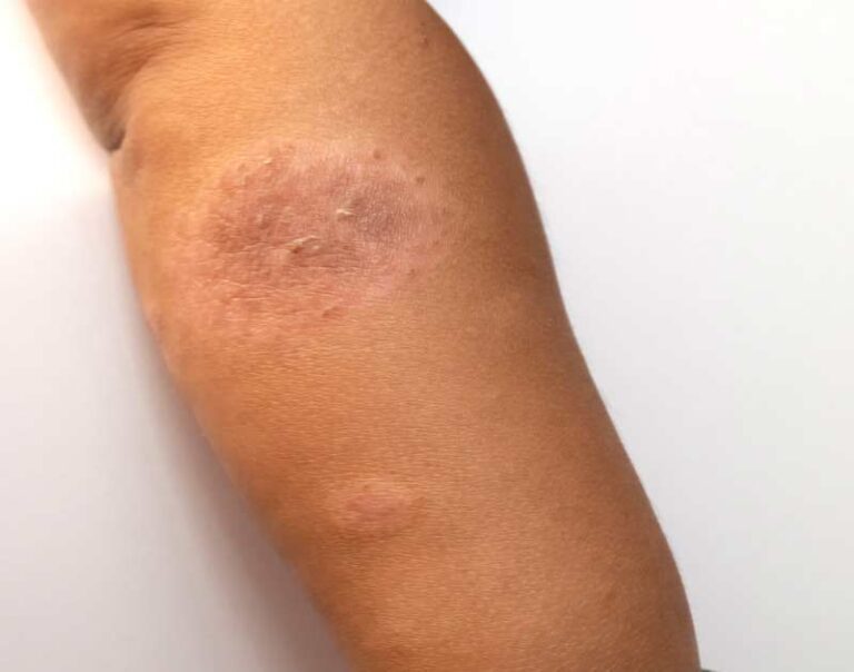 A close-up of a person's arm with a large, round, dry, and scaly patch of skin, possibly indicating a skin condition such eczema, against a plain white background.