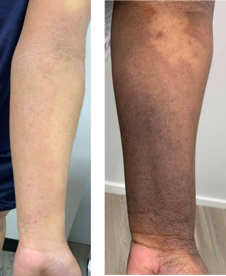 Two forearms side by side; the left arm is light-skinned with some pale patches, while the right arm is darker-skinned with noticeable discoloration and varying skin tones. Both arms are shown from wrist to elbow.