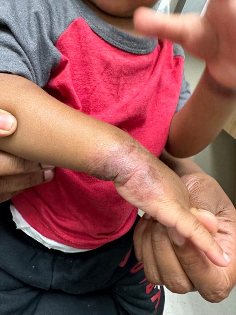 A young child with eczema on their forearm and wrist is being gently held and supported by an adult. The child's shirt is red and gray.