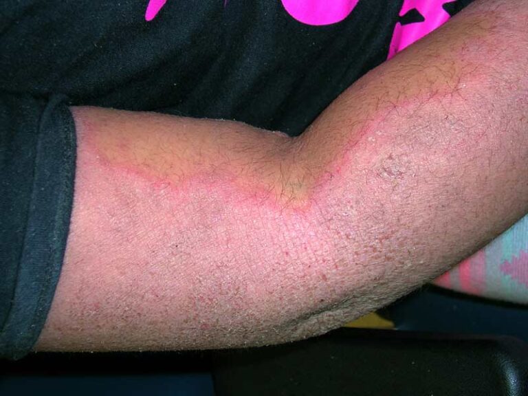A close-up of a person's bent arm showing a red, irritated, and dry patch of skin along the elbow, possibly indicating eczema or dermatitis. The person is wearing a black shirt with a pink design.