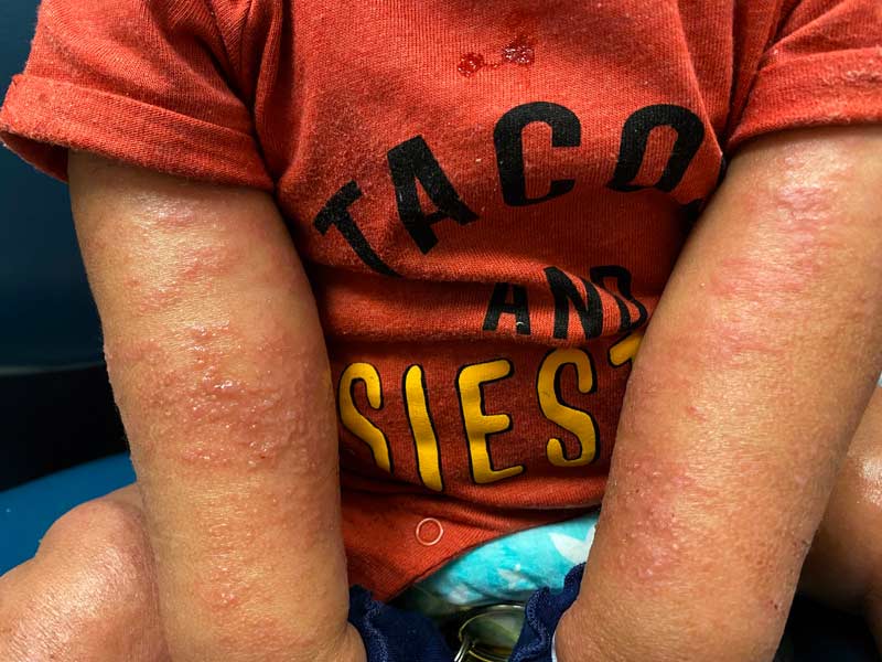 A child wearing a red shirt has visible red, irritated, and scaly patches of eczema on both forearms. The skin appears dry and inflamed.