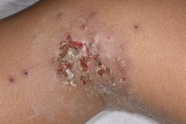 Un primer plano de la piel de una persona que muestra un conjunto de llagas rojas, con costras y costras, rodeadas de sequedad e irritación sobre una tez marrón.