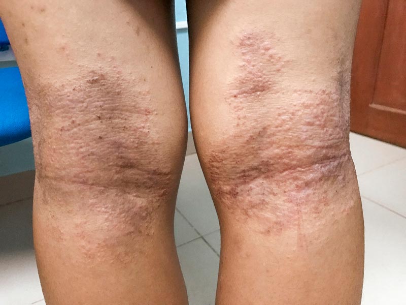 Two knees with dry, scaly, and discolored patches of skin, suggesting a skin condition such as eczema or dermatitis. The affected areas appear rough and irritated.