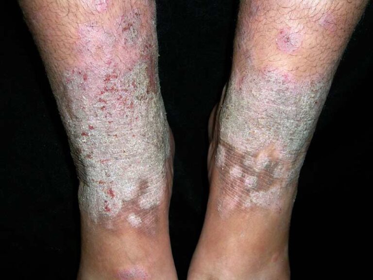 Close-up of the lower legs and ankles showing red, scaly, and inflamed skin patches with some areas appearing dry and flaky, likely indicating a skin condition such as eczema or psoriasis.