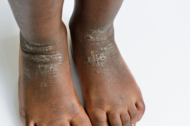 Close-up of a person’s feet and ankles with dark skin showing dry, scaly, and cracked patches, likely from eczema or another skin condition, against a white background.