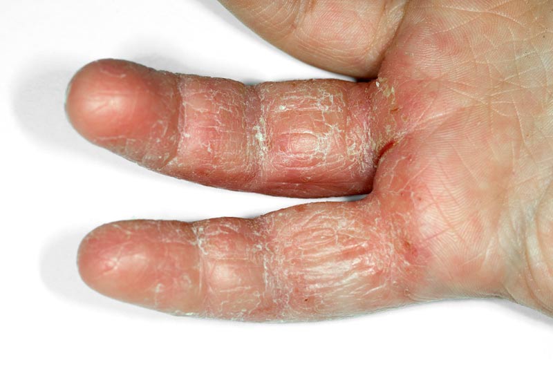 A close-up of a person's hand showing dry, red, cracked, and scaly skin on the fingers and palm, suggesting irritation or a skin condition such as eczema or dermatitis.
