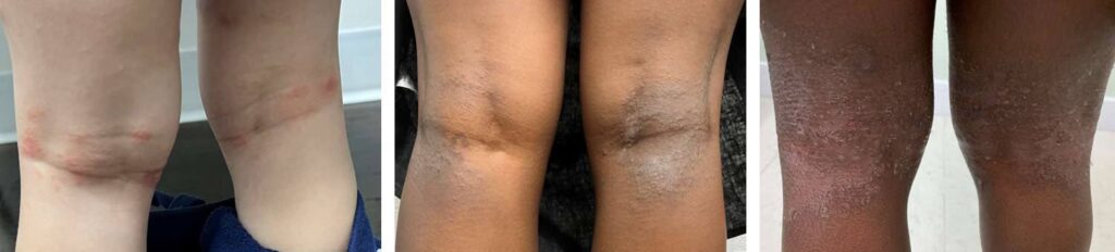 Three pairs of the backs of knees of children showing eczema on the skin: the first with red, irritated patches; the second with dry, darkened areas; and the third with thick, scaly, and inflamed skin behind the knees.